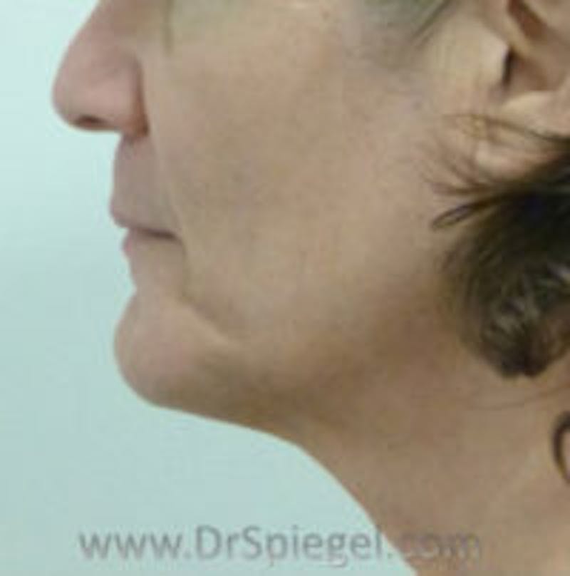 Trachea Shave Before & After Gallery - Patient 157140234 - Image 2