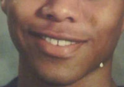 Mandible Contouring Before & After Gallery - Patient 157140238 - Image 1