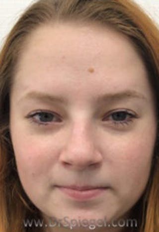 Botox / Dysport / Jeuveau / Xeomin Before & After Gallery - Patient 157140236 - Image 4