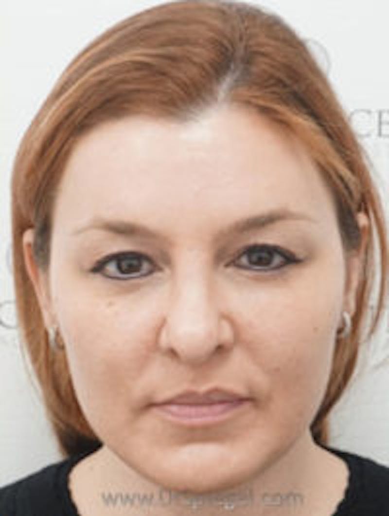 CO2 Laser Before & After Gallery - Patient 157140240 - Image 2