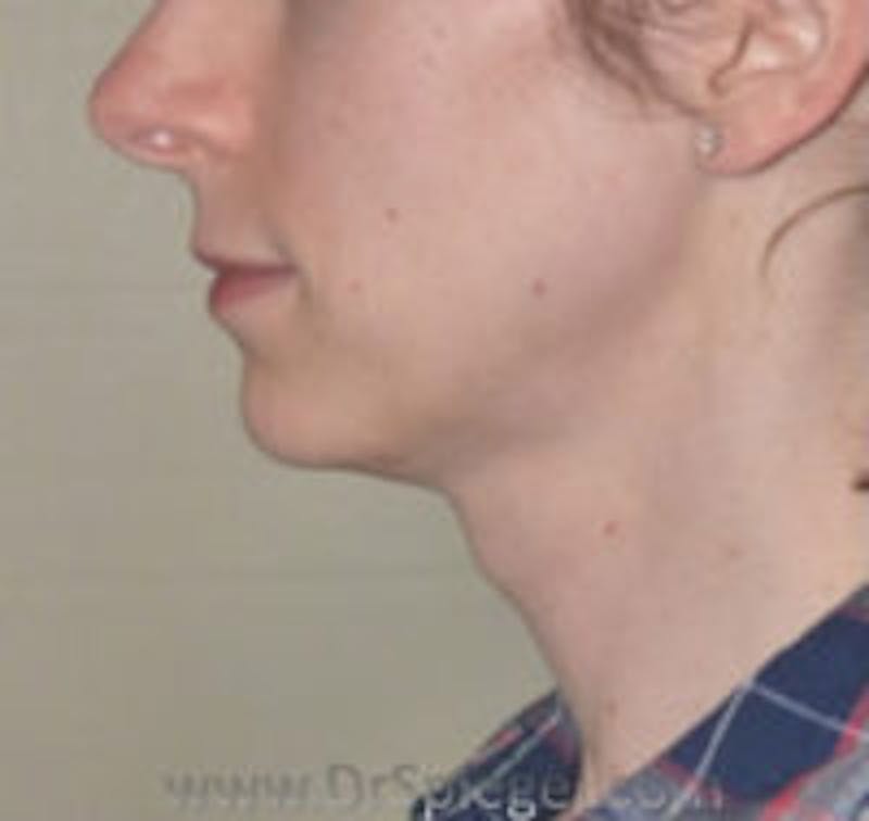 Trachea Shave Before & After Gallery - Patient 157140252 - Image 1