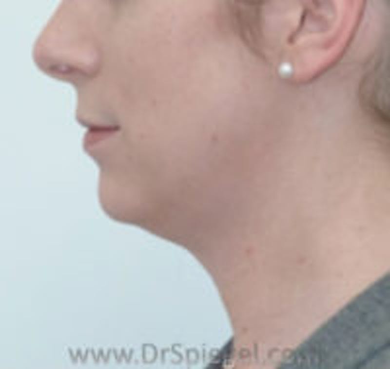 Trachea Shave Before & After Gallery - Patient 157140252 - Image 2