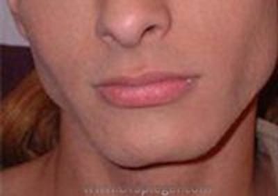 Mandible Contouring Before & After Gallery - Patient 157140253 - Image 1