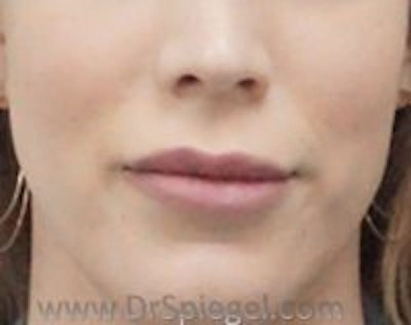 Lip Lift Before & After Gallery - Patient 157140255 - Image 1