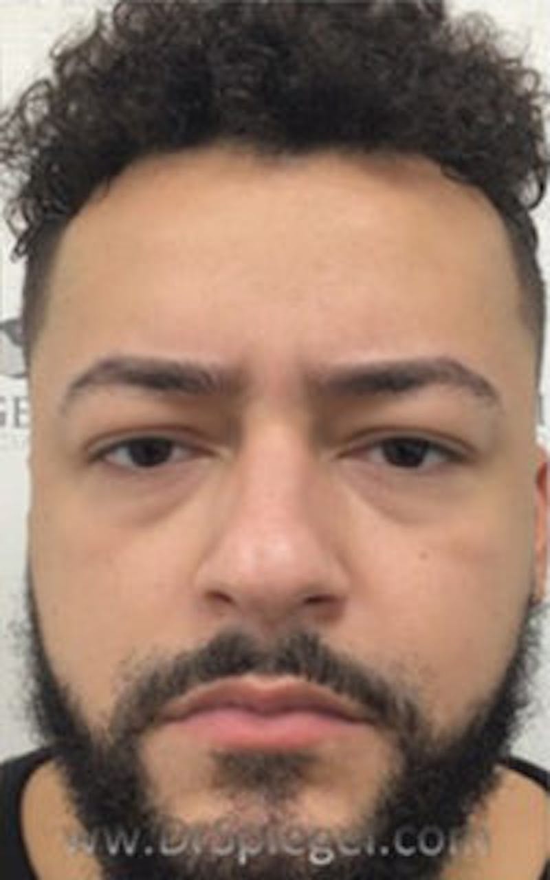 Botox / Dysport / Jeuveau / Xeomin Before & After Gallery - Patient 157140259 - Image 2