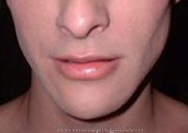Mandible Contouring Before & After Gallery - Patient 157140253 - Image 2