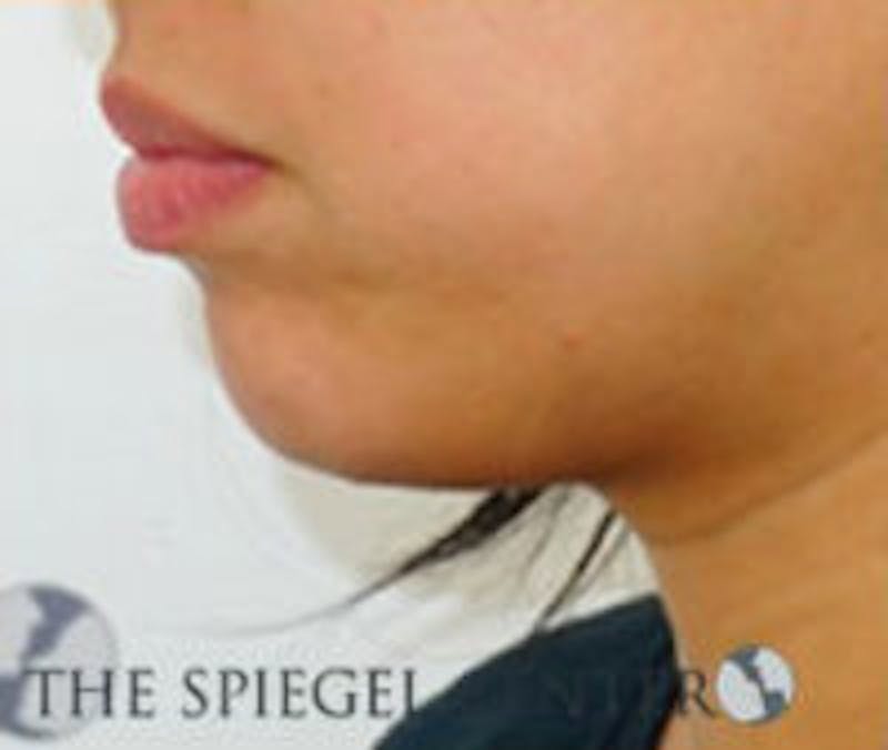 Chin Filler Before & After Gallery - Patient 157140256 - Image 3