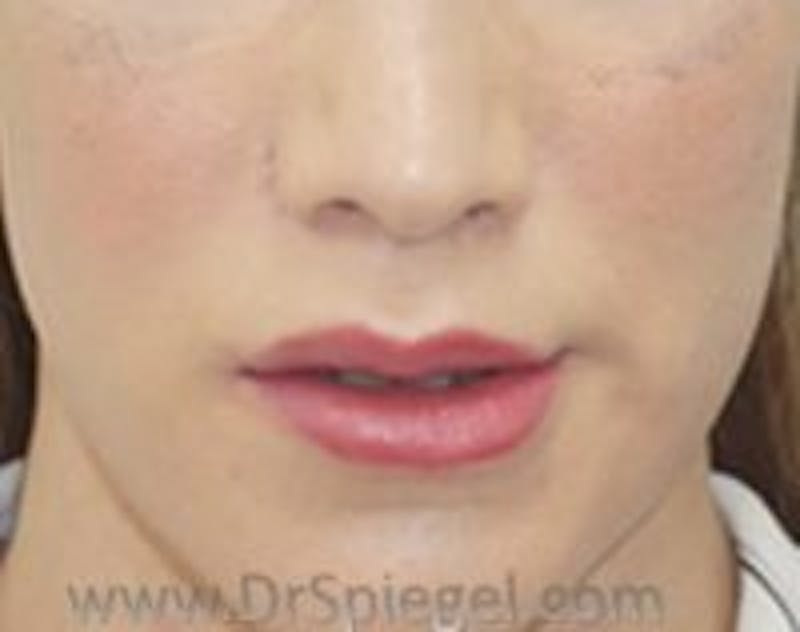 Lip Lift Before & After Gallery - Patient 157140255 - Image 2