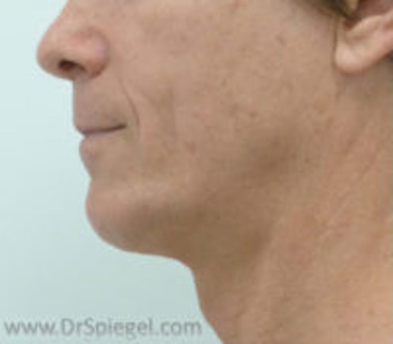 Trachea Shave Before & After Gallery - Patient 157140257 - Image 1