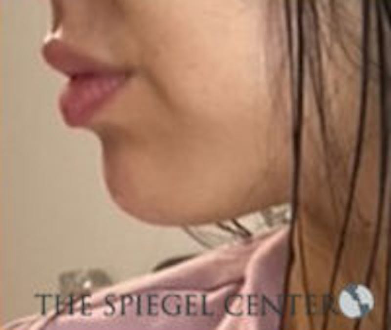 Chin Filler Before & After Gallery - Patient 157140256 - Image 4
