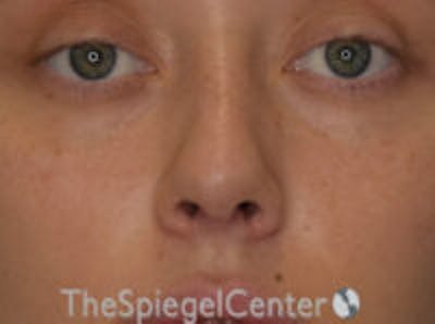 Rhinoplasty Before & After Gallery - Patient 157140242 - Image 4