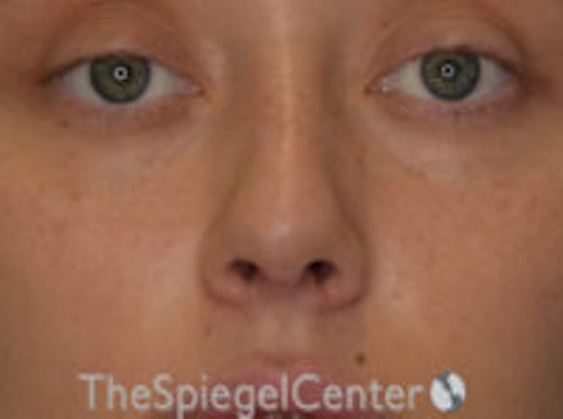 Rhinoplasty Before & After Gallery - Patient 157140242 - Image 4