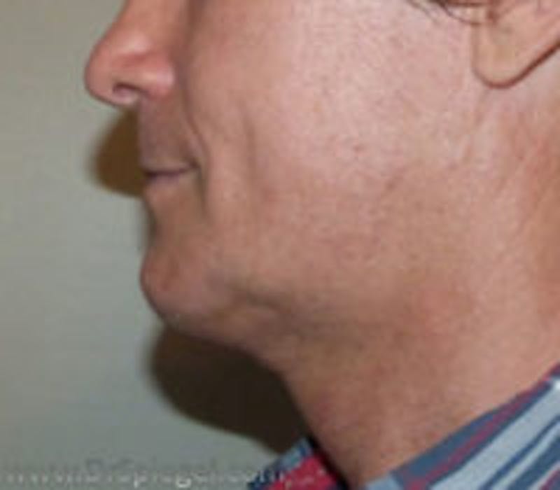 Trachea Shave Before & After Gallery - Patient 157140257 - Image 2