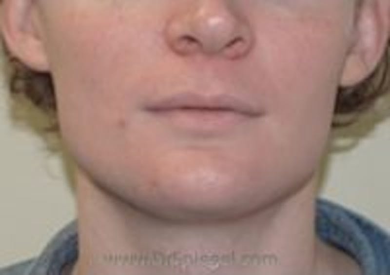 Mandible Contouring Before & After Gallery - Patient 157140263 - Image 1