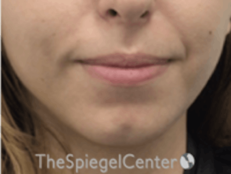 Chin Filler Before & After Gallery - Patient 157140268 - Image 1