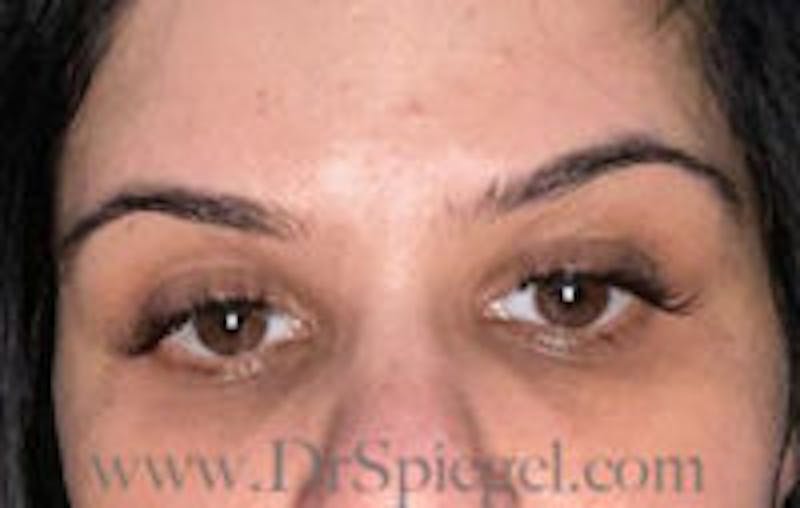 Botox Browlift Before & After Gallery - Patient 157140261 - Image 2