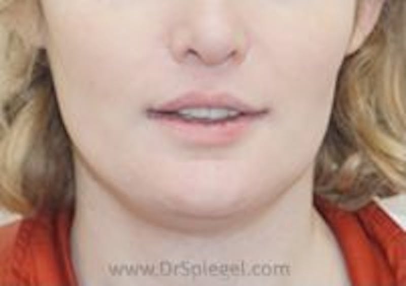 Mandible Contouring Before & After Gallery - Patient 157140263 - Image 2