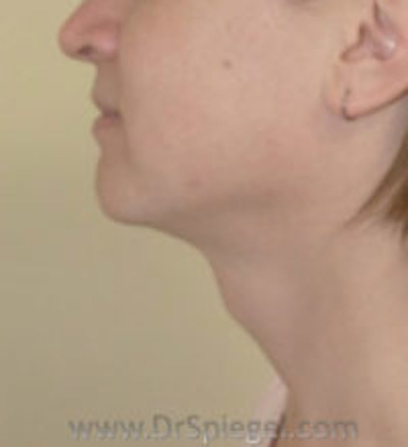 Trachea Shave Before & After Gallery - Patient 157140265 - Image 1