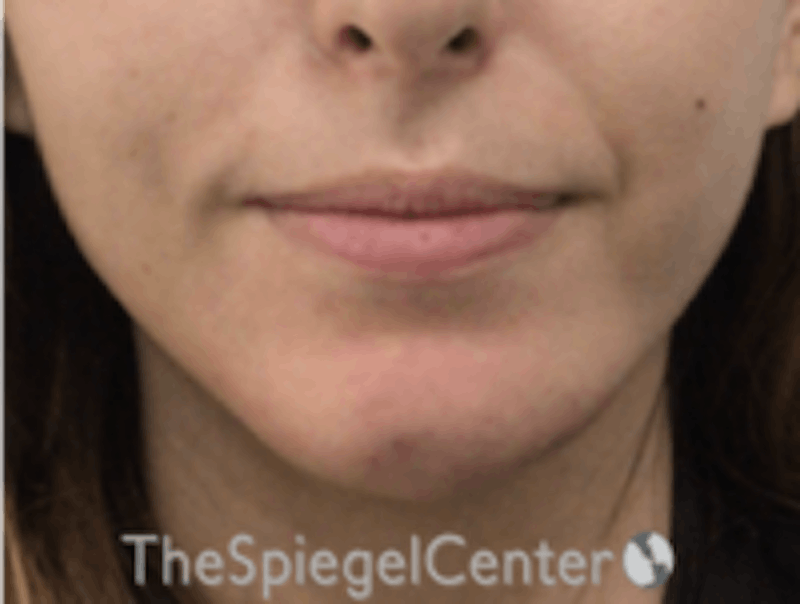 Chin Filler Before & After Gallery - Patient 157140268 - Image 2