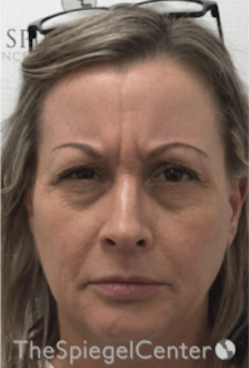Botox / Dysport / Jeuveau / Xeomin Before & After Gallery - Patient 157140278 - Image 1