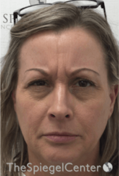 Botox / Dysport / Jeuveau / Xeomin Before & After Gallery - Patient 157140278 - Image 1