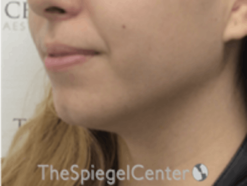 Chin Filler Before & After Gallery - Patient 157140268 - Image 3