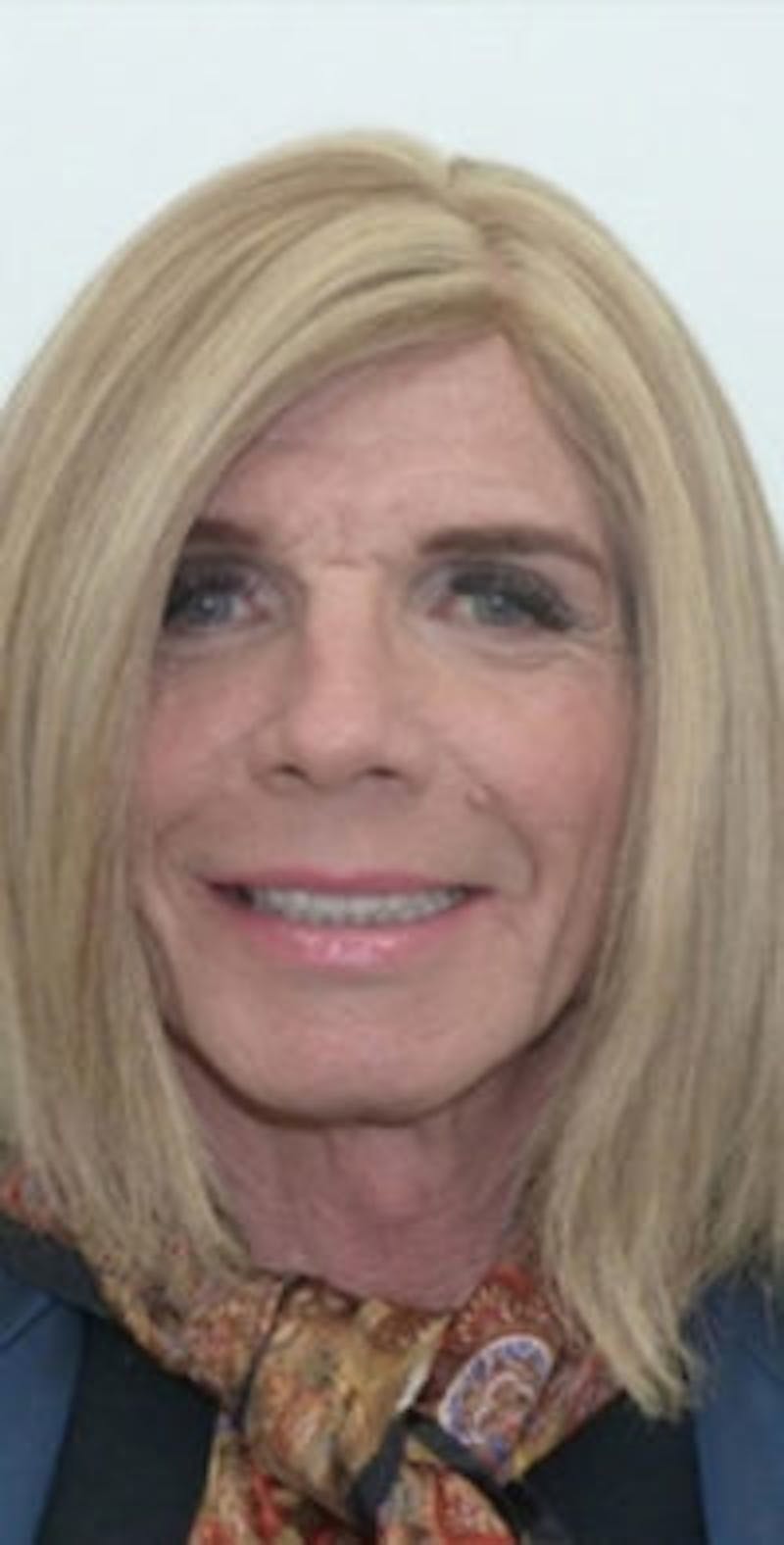 FFS Before & After Gallery - Patient 157140276 - Image 1
