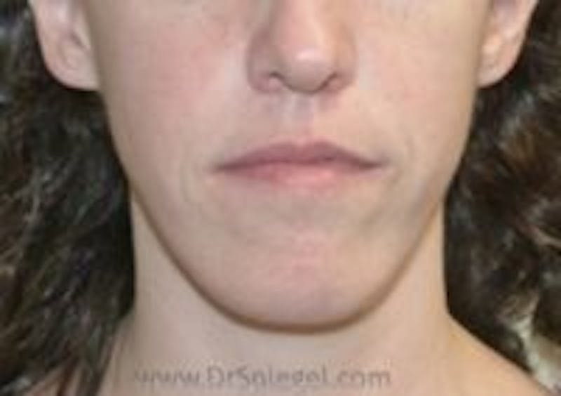 Mandible Contouring Before & After Gallery - Patient 157140269 - Image 1