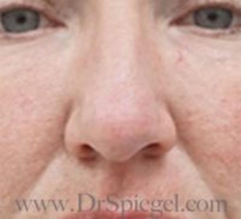 Rhinoplasty Before & After Gallery - Patient 157140274 - Image 3