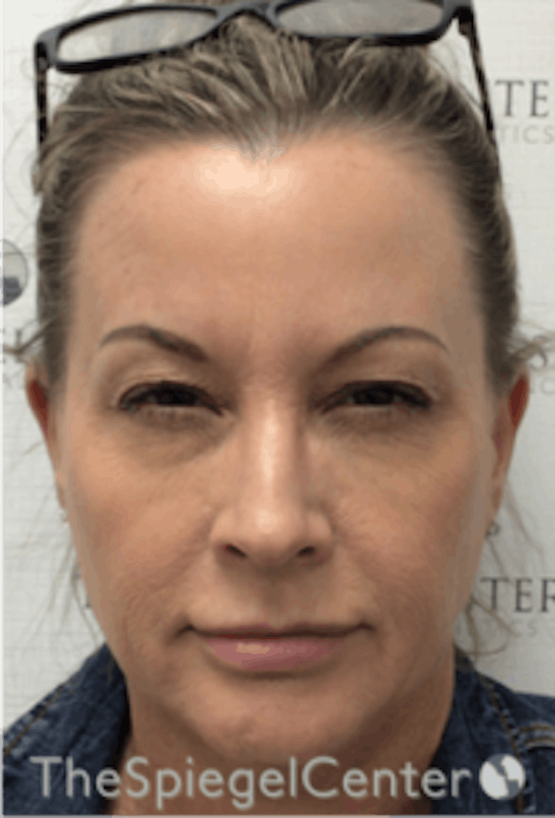 Botox / Dysport / Jeuveau / Xeomin Before & After Gallery - Patient 157140278 - Image 2