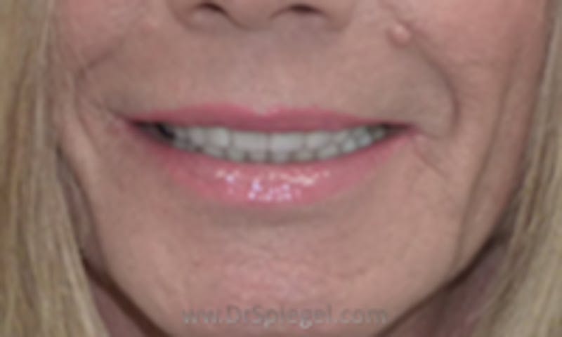 Lip Lift Before & After Gallery - Patient 157140271 - Image 1