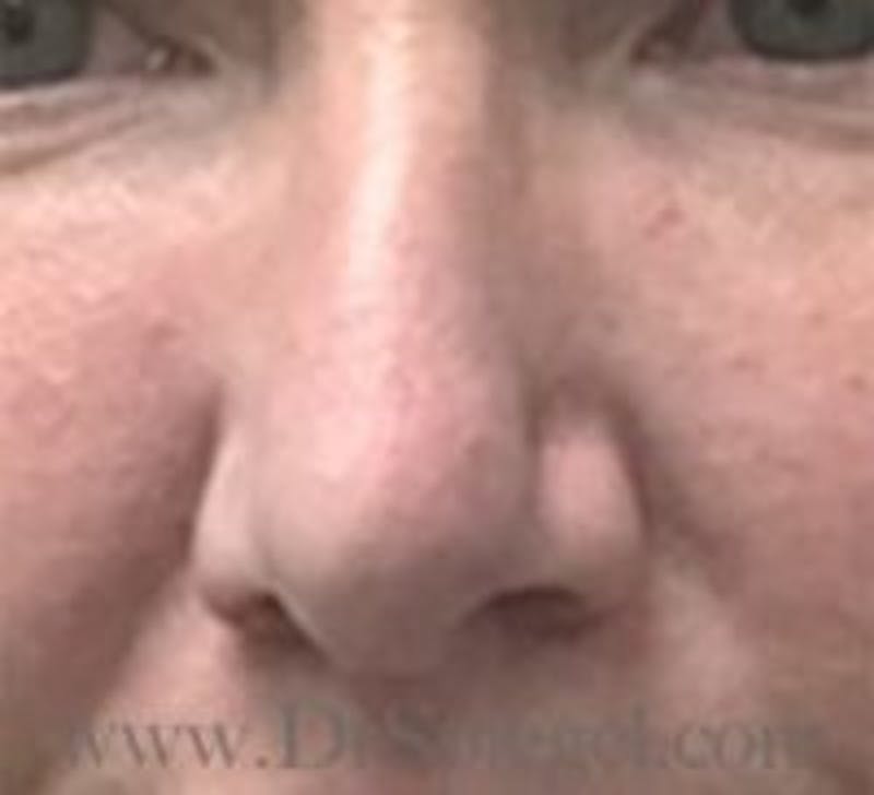 Rhinoplasty Before & After Gallery - Patient 157140274 - Image 4