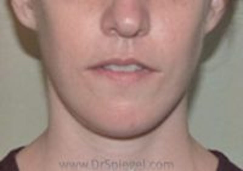 Mandible Contouring Before & After Gallery - Patient 157140269 - Image 2