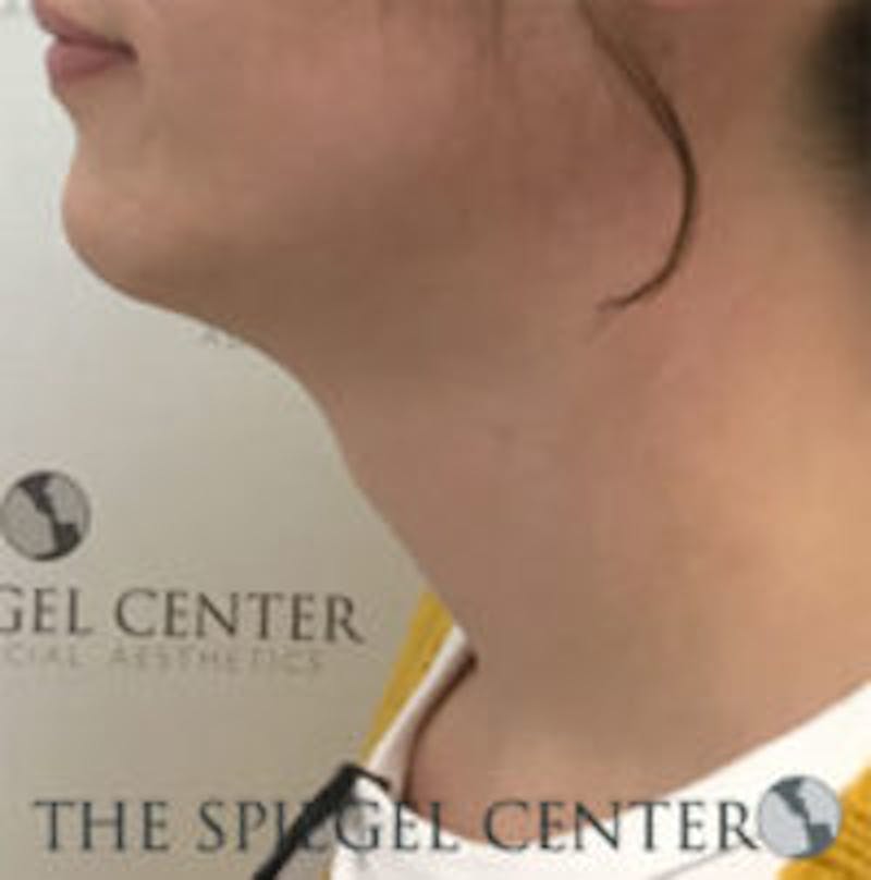 Trachea Shave Before & After Gallery - Patient 157140272 - Image 1