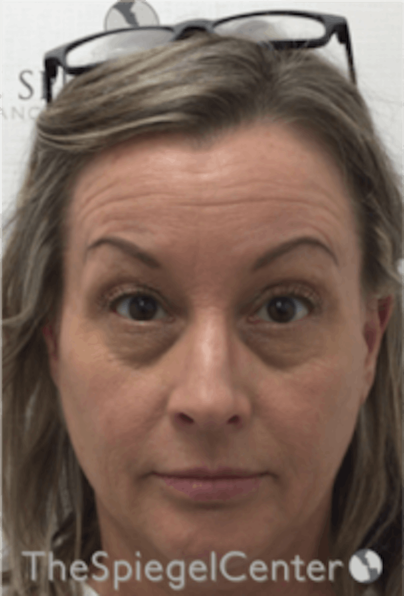 Botox / Dysport / Jeuveau / Xeomin Before & After Gallery - Patient 157140278 - Image 3