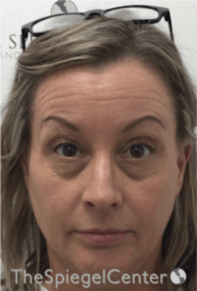 Botox / Dysport / Jeuveau / Xeomin Before & After Gallery - Patient 157140278 - Image 3