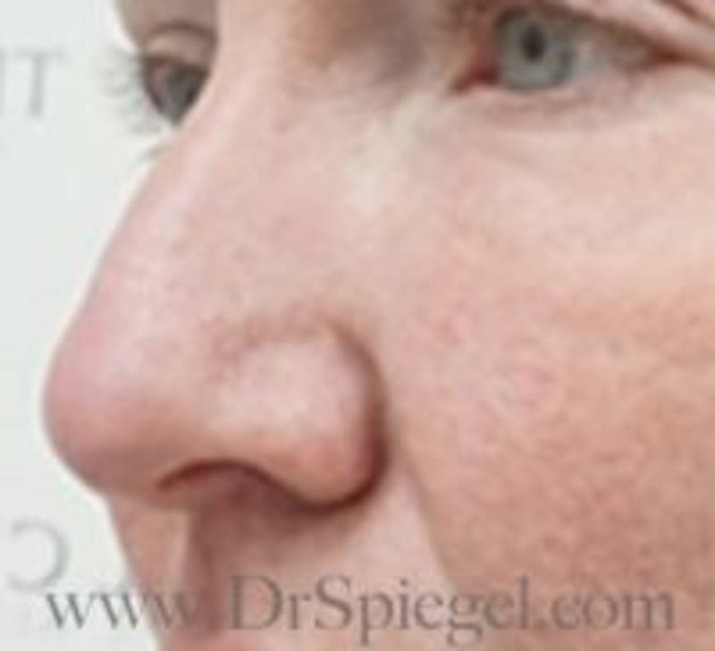 Rhinoplasty Before & After Gallery - Patient 157140274 - Image 1