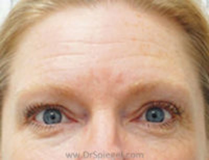 Botox Browlift Before & After Gallery - Patient 157140277 - Image 1