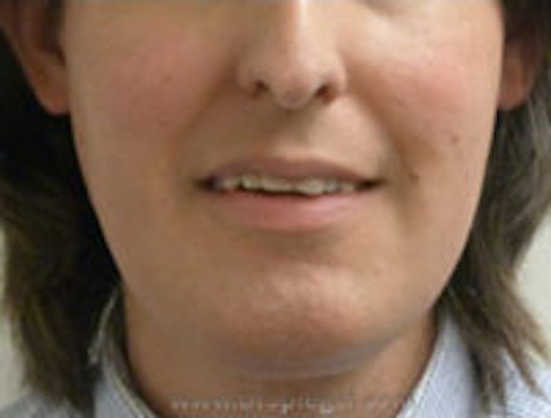 Mandible Contouring Before & After Gallery - Patient 157140279 - Image 1