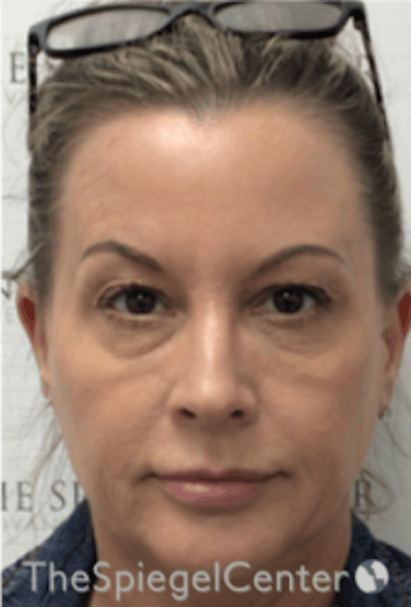 Botox / Dysport / Jeuveau / Xeomin Before & After Gallery - Patient 157140278 - Image 4
