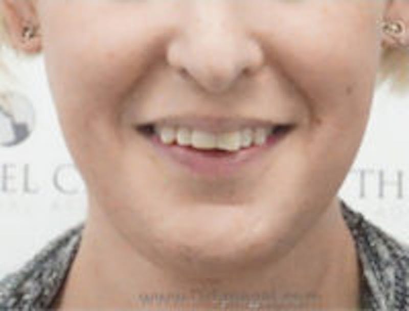 Mandible Contouring Before & After Gallery - Patient 157140279 - Image 2