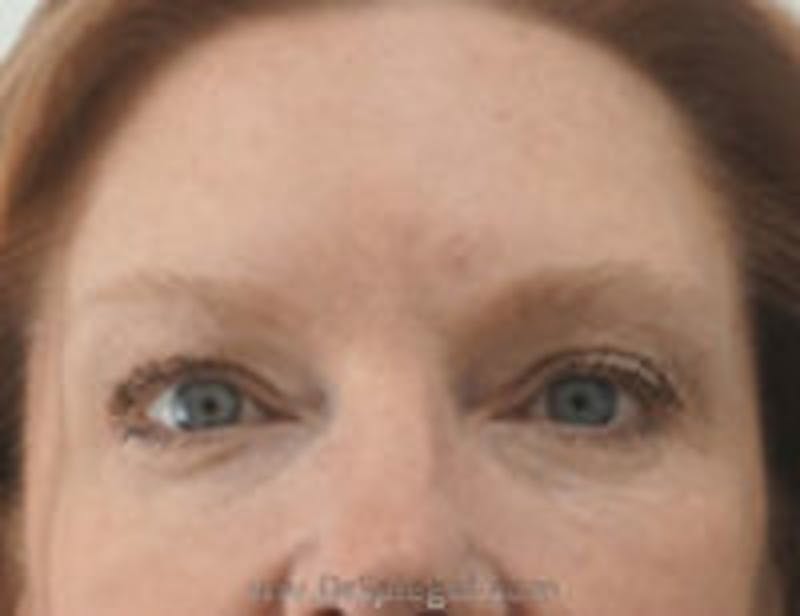 Botox Browlift Before & After Gallery - Patient 157140277 - Image 2