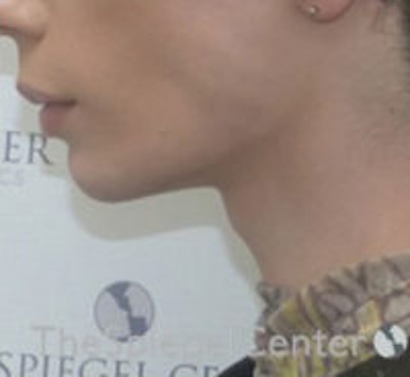 Trachea Shave Before & After Gallery - Patient 157140281 - Image 1