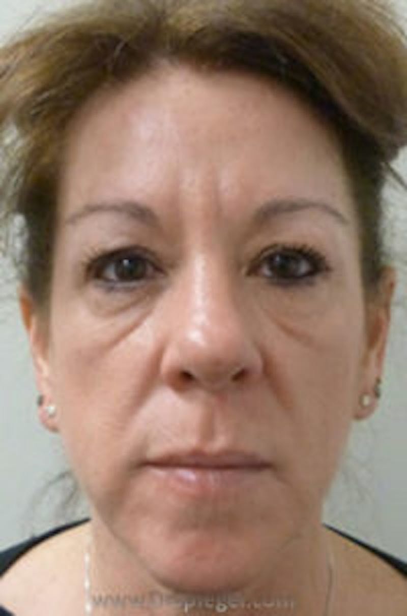 Liquid Face Lift Before & After Gallery - Patient 183935100 - Image 1