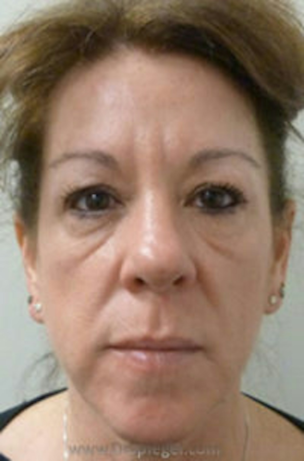Dermal Fillers in Boston Before and After Photos
