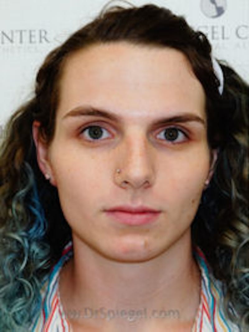 FFS Before & After Gallery - Patient 157140289 - Image 1