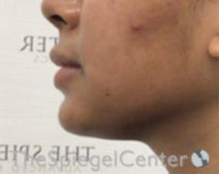 Chin Filler Before & After Gallery - Patient 157140282 - Image 4