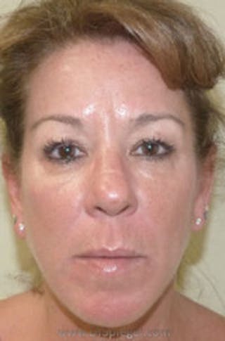 Liquid Face Lift Before & After Gallery - Patient 183935100 - Image 2