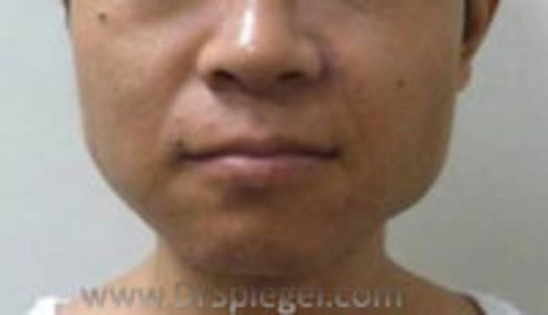 Mandible Contouring Before & After Gallery - Patient 157140285 - Image 1
