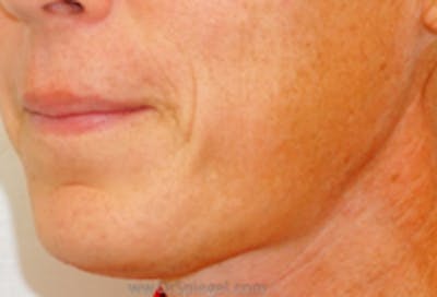 Lip Lift Before & After Gallery - Patient 157140286 - Image 1